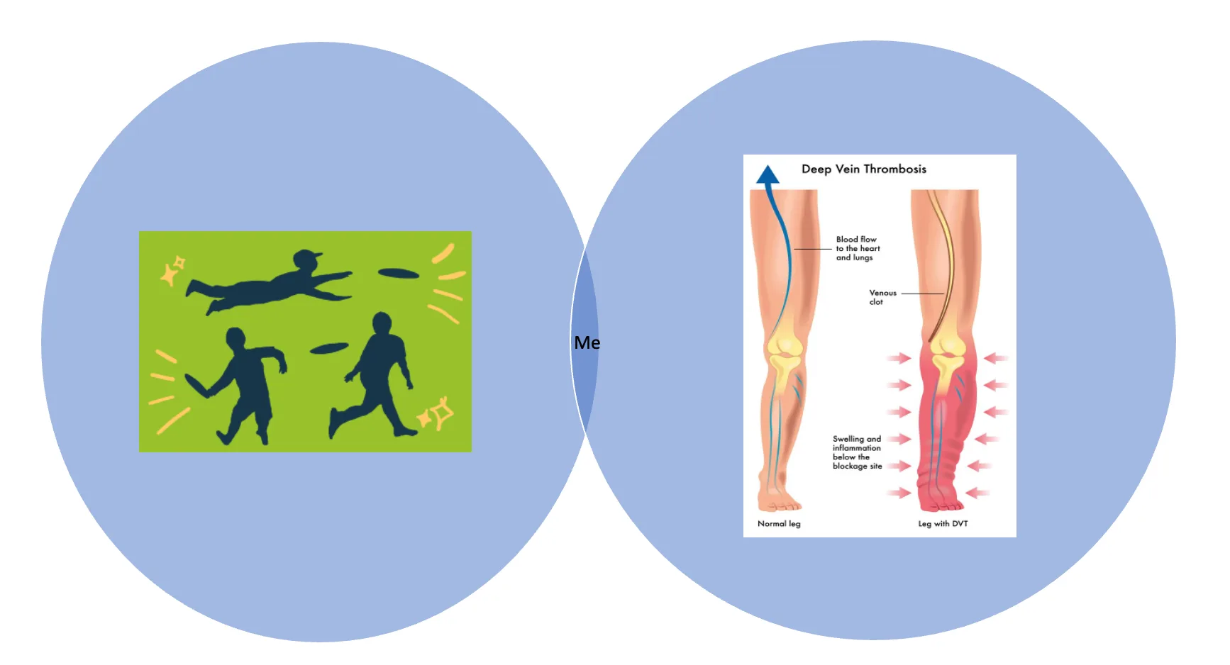Venn diagram overlapping an ultimate-frisbee illustration and a deep-vein-thrombosis leg diagram, with "Me" at the intersection